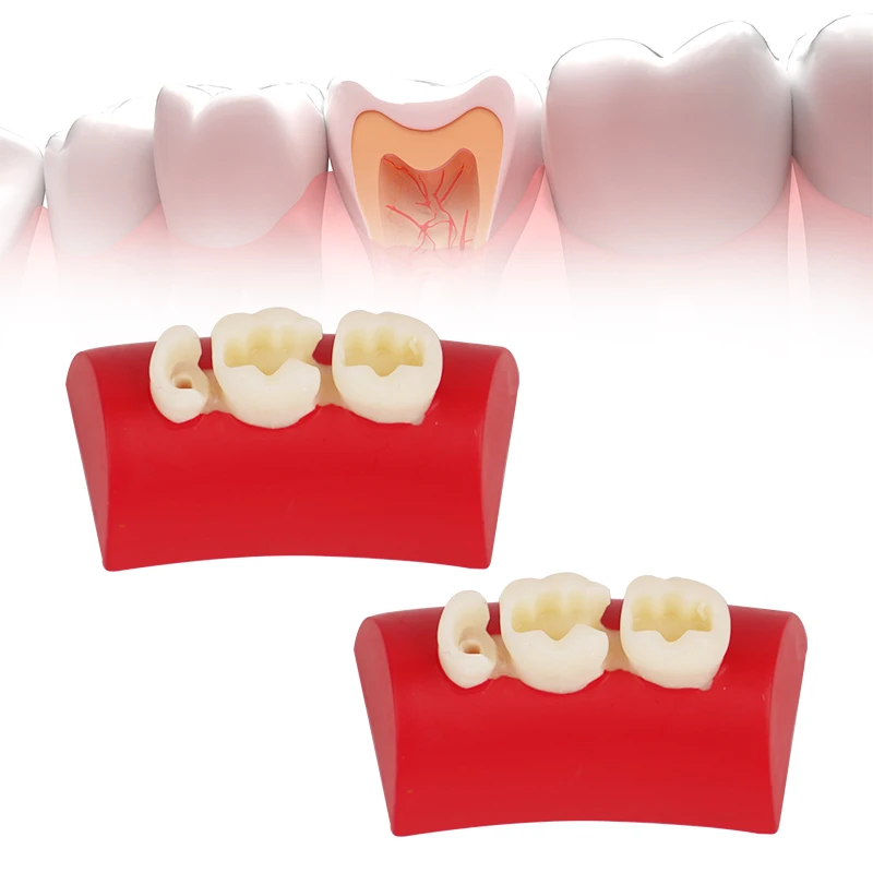 Модель ротового наполнения стоматологическая инкрустация модель для упражнений
