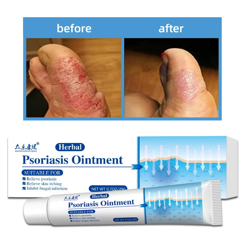 

Herbal Psoriasis Ointment Antibacterial Anti-itch Relief Eczema Skin Treatment Dermatitis Rash Urticaria Desquamation Body Care