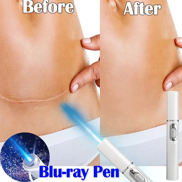 

Soft Scar Remover Acne Laser Pen Blue Light Therapy Portable Wrinkle Removal Machine Varicose Veins Treatment Massage Relax