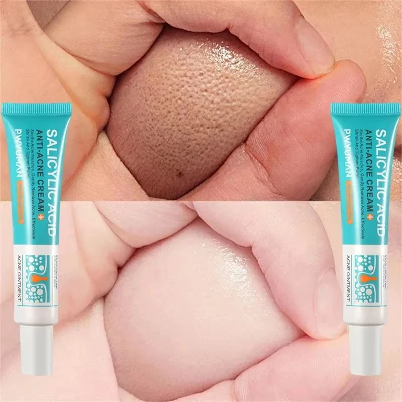 Крем для сужения пор с салициловой кислотой быстрое устранение больших удаление