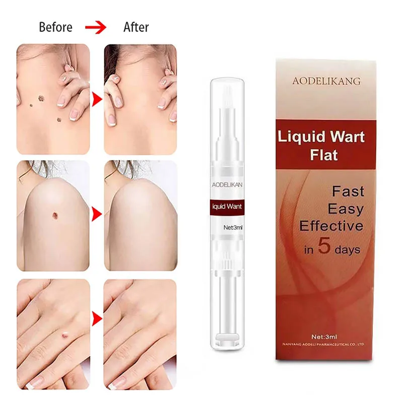 

Quickly Remove Male And Female Skin Wart Formula Skin Tag to Remove Pen Remover Anti Verruca Remedy Liquid Pen Skin Care