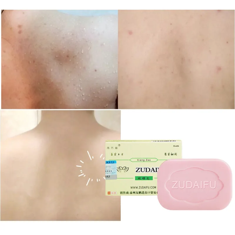 

3 шт./партия, мазь при псориазе дерматите экземе