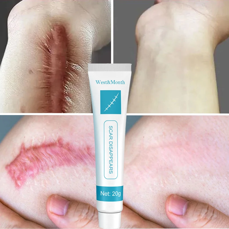 

Effective Acne Surgical Scar Removal Cream Treatment Face Pimples Stretch Marks Promote Body Skin Whitening Smooth Care Creams