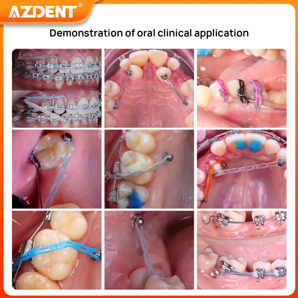 Рисунок 6 - Зубная Ортодонтическая эластичная Силовая цепь AZDENT