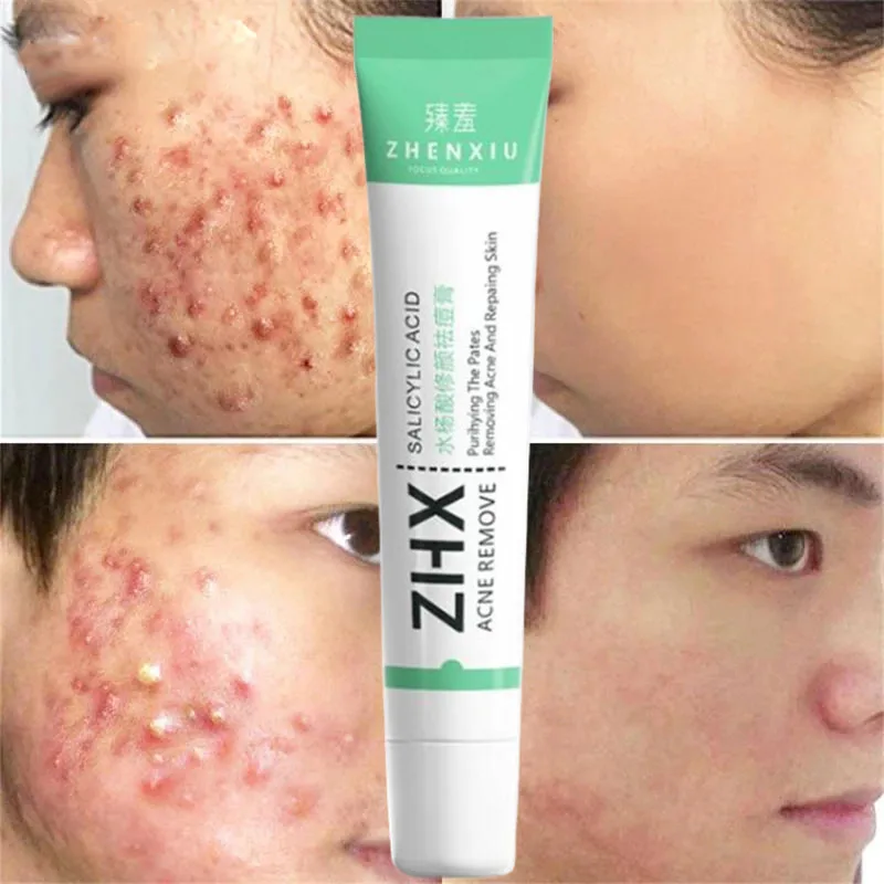 

Effective Acne Removal Serum Salicylic Acid Anti-Acne Face Cream Fade Acne Scar Shrink Pores Oil Control Moisturizing Care