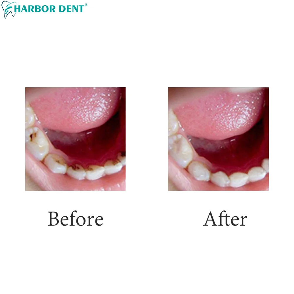 Стоматологический ультразвуковой прибор для чистки зубов с 4 наконечниками