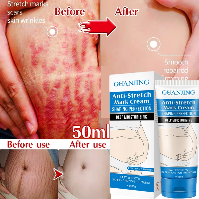 

Natural Body Cream 80g Stretch Marks Removal Cream Eliminate Acne Pregnancy Scars Maternity Repair Anti Winkle Skin Firming Care