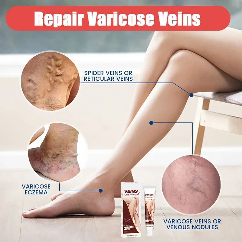 Крем для здоровья Vein Defense помогает улучшить внешний вид пауковых вен