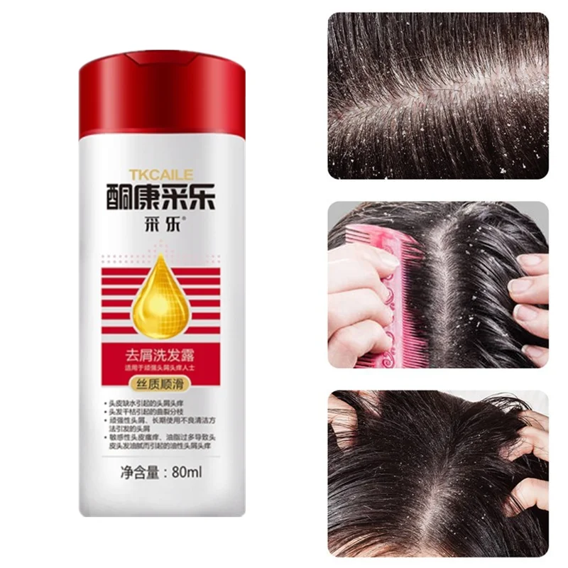

Control Oil Relieve Itching Dandruff Shampoo Washing Anti Flakes Scalp Anti-Dandruff Hair Shampoos Anti-Mite Reducing Dandruff