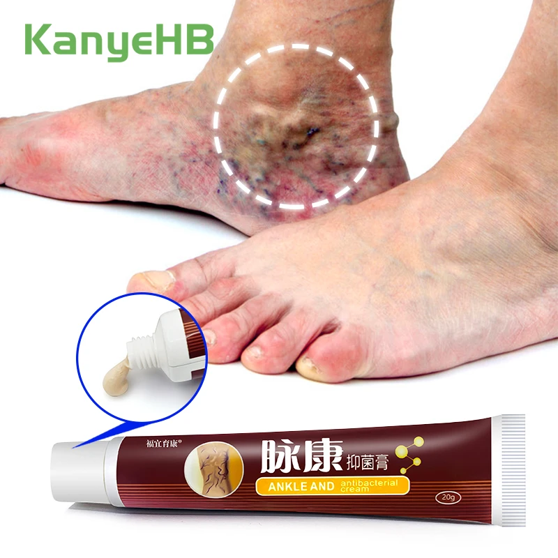 

1pcs Varicose Veins Relief Cream Leg Vasculitis Phlebitis Spider Shape Vein Pain Ointment Chinese Herbal Medical Plaster S034