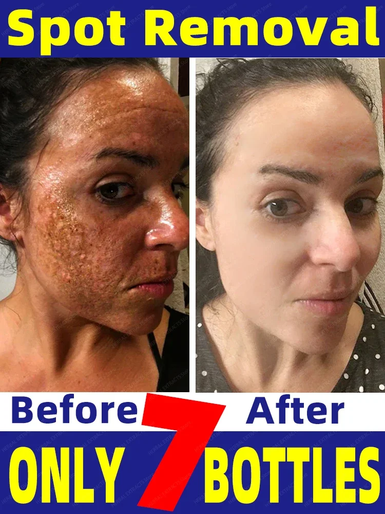 

Dark Spot Remover For Face Removal Cream Age Sun Black Spots Freckles Melasma