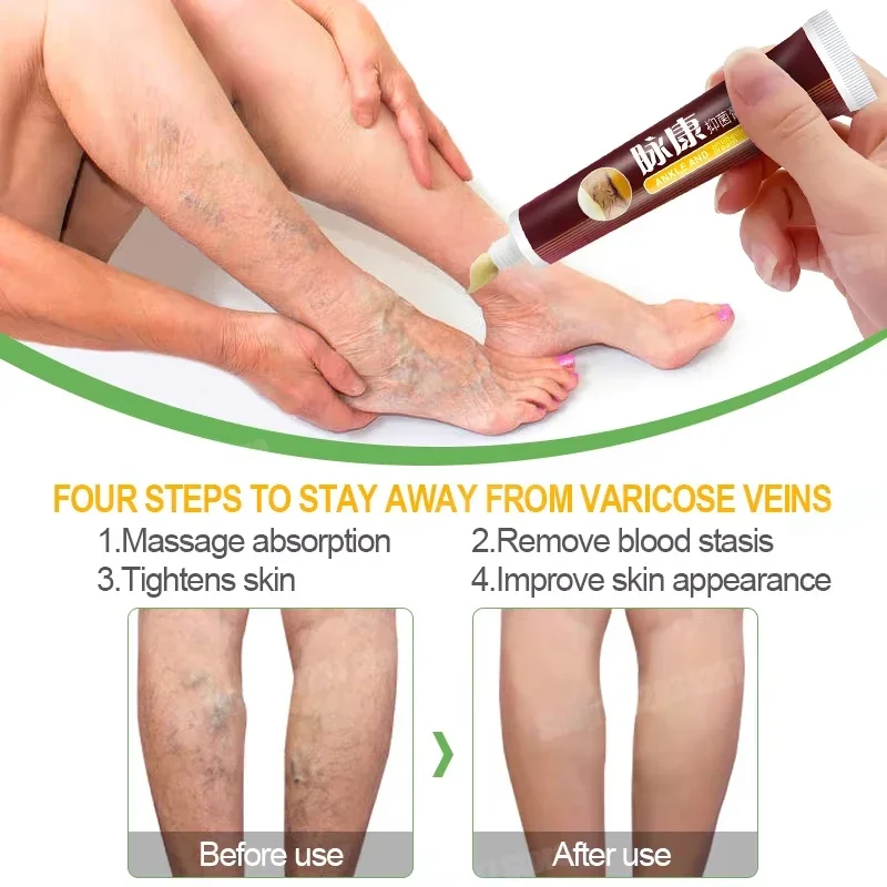 Крем для лечения варикозного расширения вен удаление красных пятен крови