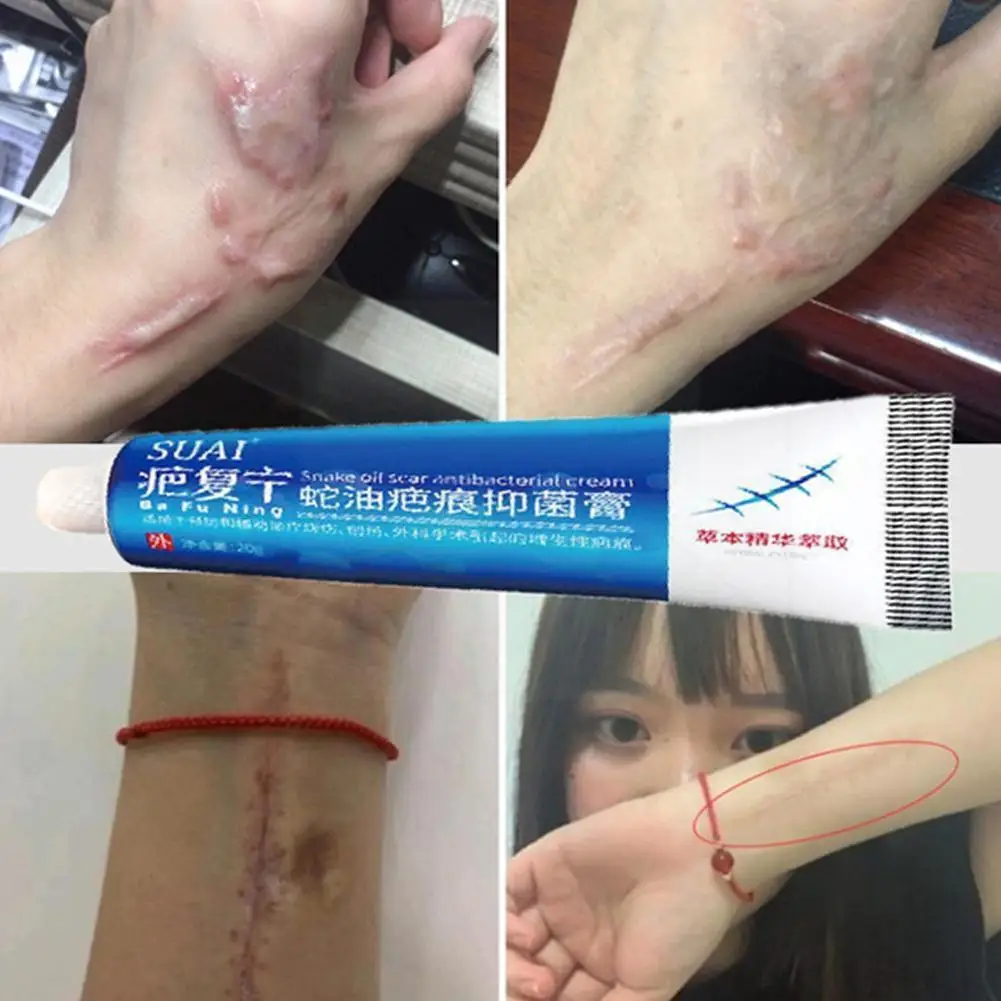 

20g Scar Removal Cream Acne Scars Gel Stretch Marks Pigmentation Smoothing Scar Body Surgical Correct Cream Repair Spots Ca O5y3