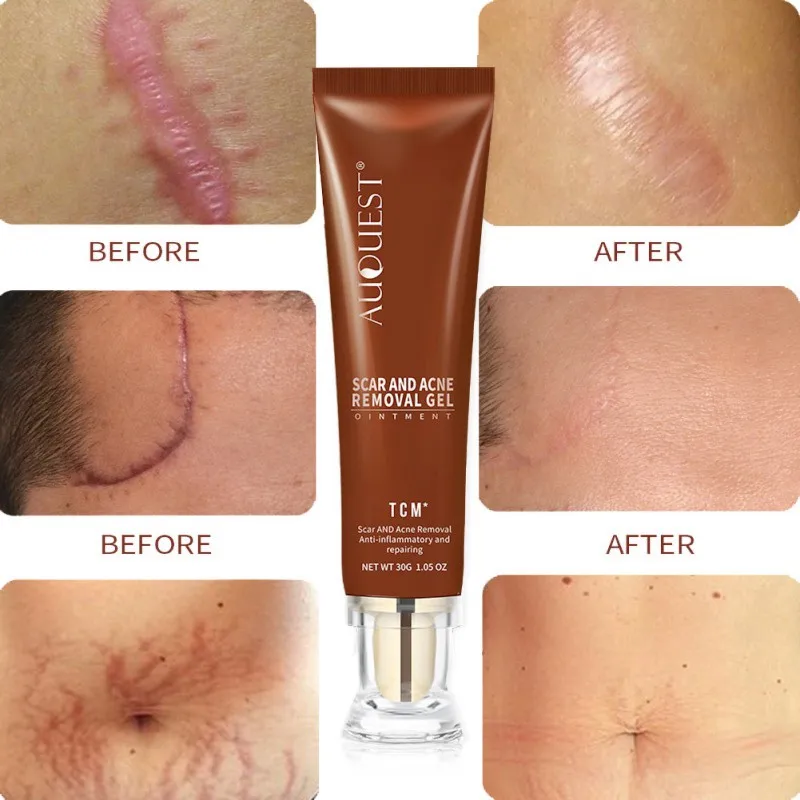 

30g Body Scar Repair Cream Gel Quickly Remove Acne Pimple Marks Essential Anti-Inflammatory Repair Skin Care