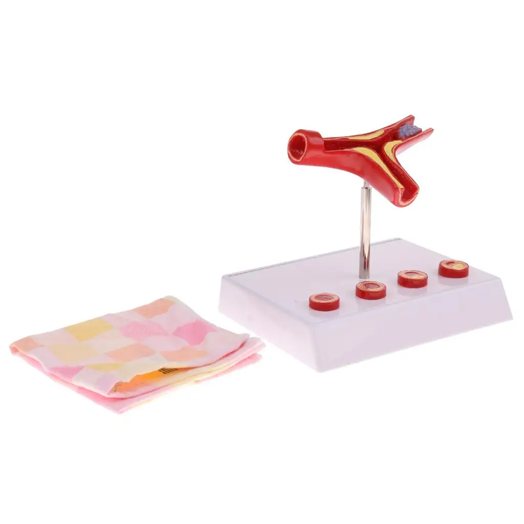 Увеличение 50x -секция человеческого сосуда Атеросклероз Тромб Сосудистый