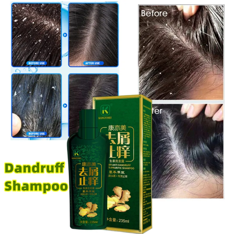 

Hair Scalp Treatment Anti Dandruff Anti Itch Essence Spray Prevent Loss Oil Control Hair Care Products Keratin Hair Treatment