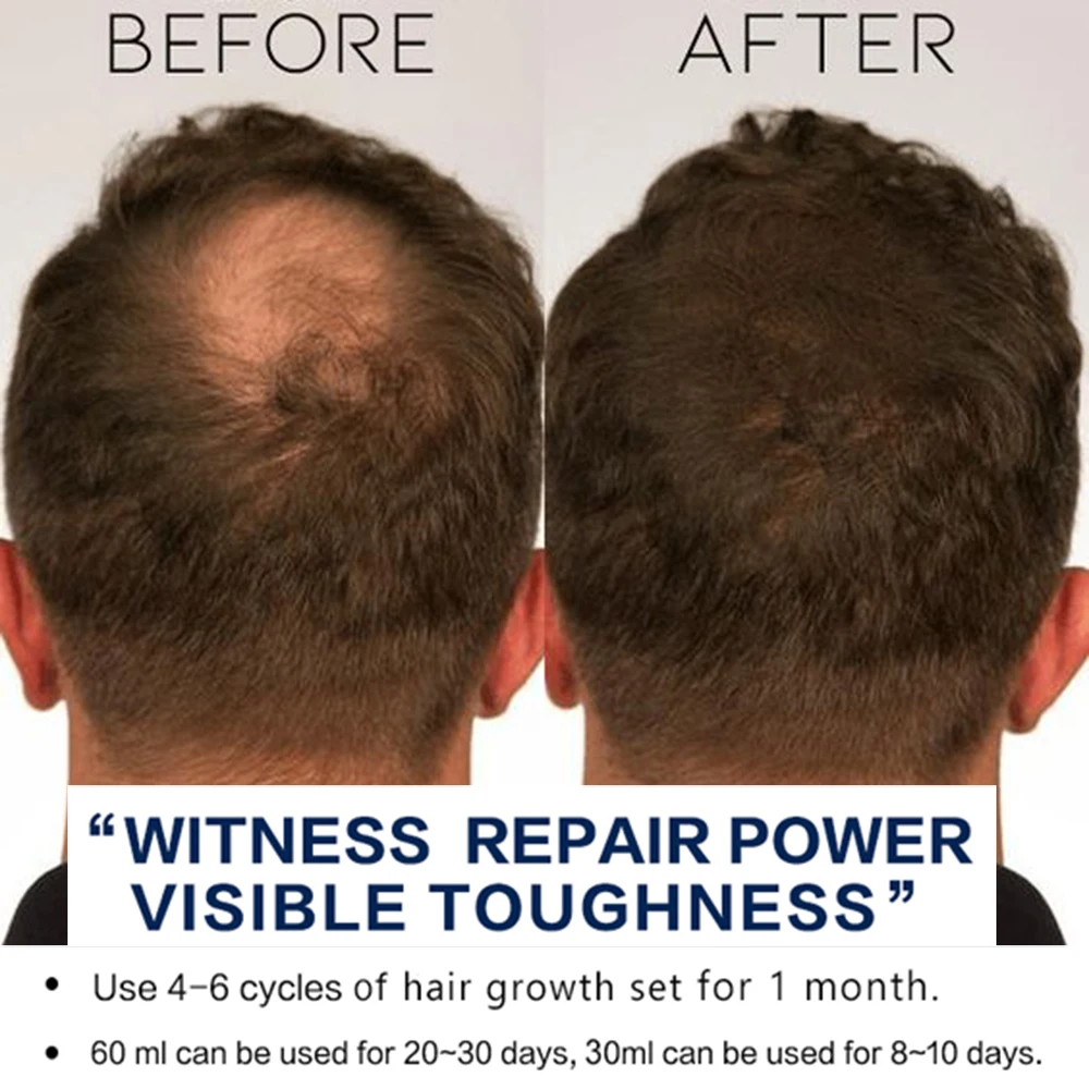 Безопасное средство для роста волос Эфирное эффективное питающее масло кожи