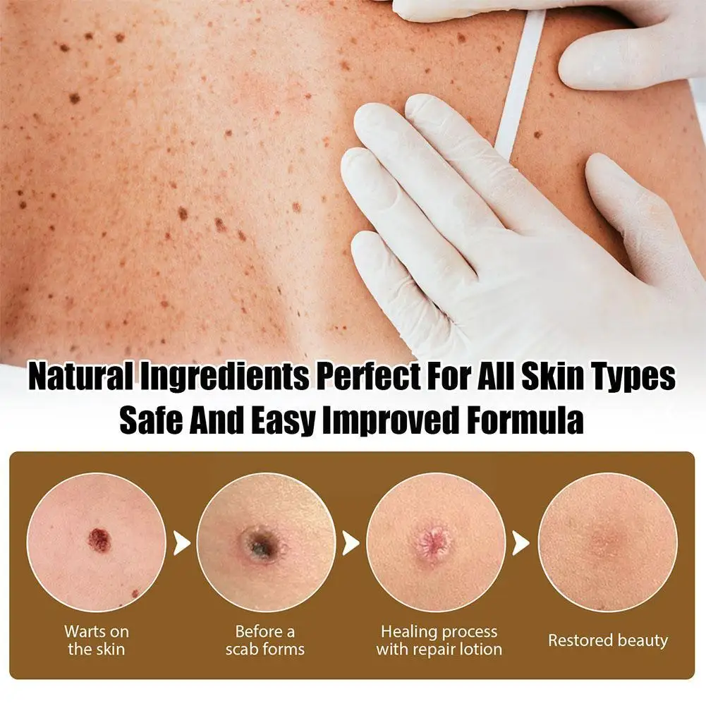 Рисунок 5 - Ремонт бородавок