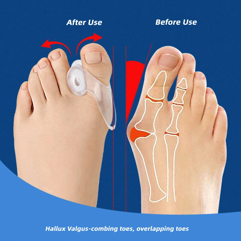 

20pieces=10pairs Gel Hallux Valgus Orthotics Foot Care Overlapping Toe Separators Splitter Silicone Bunion Adjuster Corrector