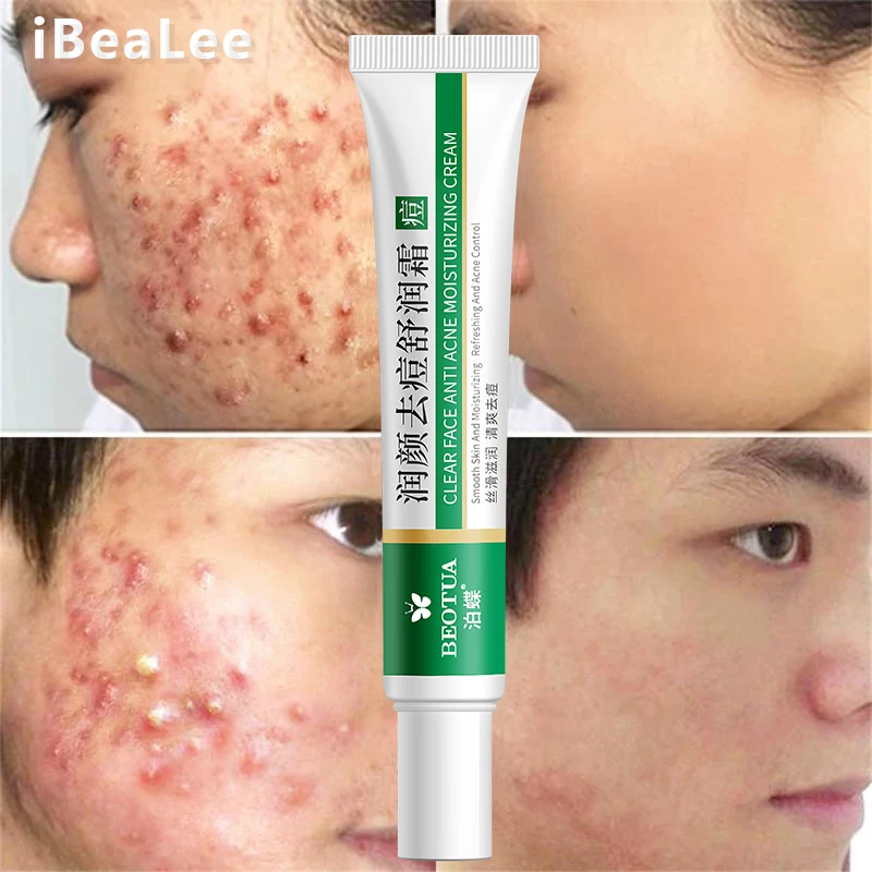 

Effective Acne Removal Cream Herbal Acne Spots Oil Control Acne Cream Skin Care Whitening Moisturizing Face Gel Skin Care 20g