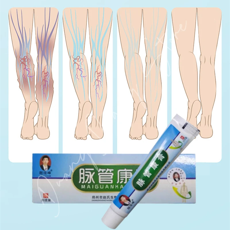 

5/10/20Pcs Natural Herbal Medicin Ointment for Varicose Veins Feet Treating Varicose Vascular Inflammation Massage Cream