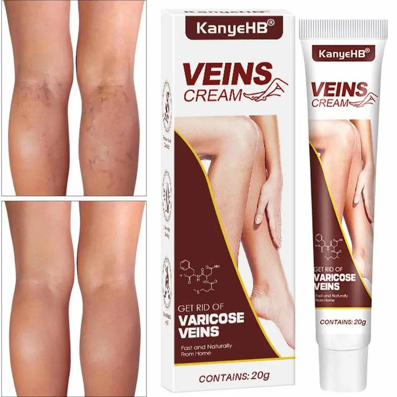 

Leg Cream For Circulation Varicose Vein Fading Balm Spider Vein Treat Reduce Appearance Of Varicose Vein Relieve Legs Discomfort