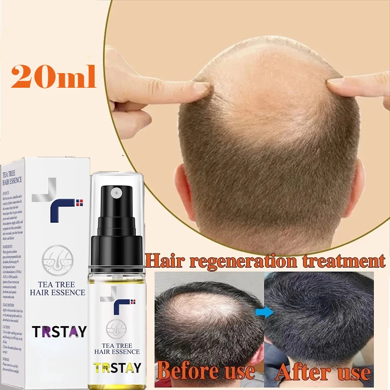 

Fast Hair Growth Hair Follicle Treatment Hair Growth Seborrheic Alopecia Hairline Upward Postpartum Hair Loss Baldness Hair Loss