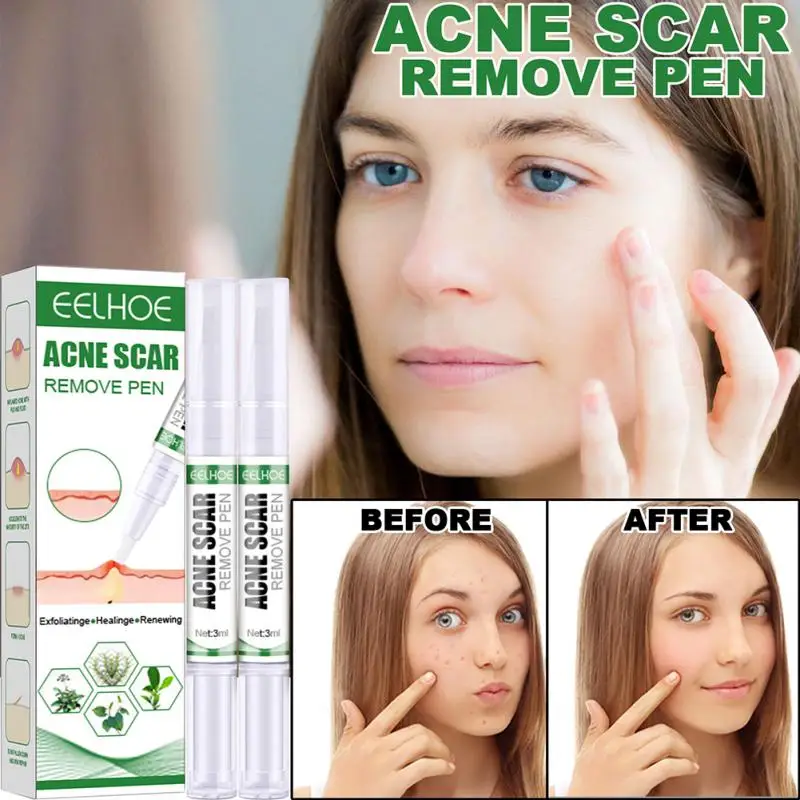 

Acne-removing Pen Skin Cleaning Repairing Acne Pits Lightening Acne Marks Acne Mild Acne Removal Liquid Skin Health Care