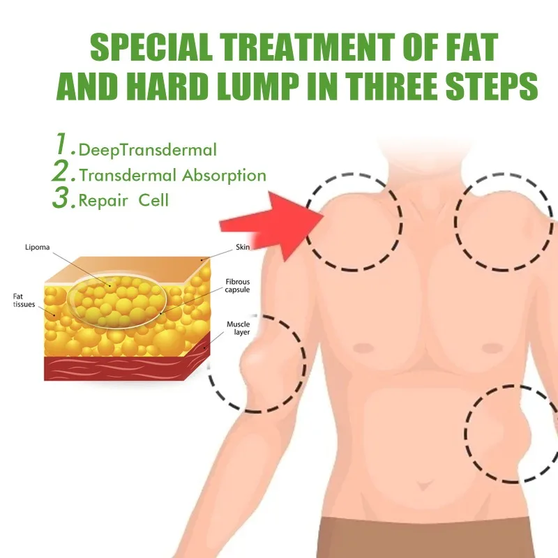 Lipoma крем для удаления жира в кусках нодулярная детоксикация средство лечения