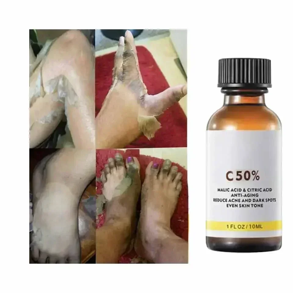 Высококачественный химический пилинг кислота суперсилие пигментация