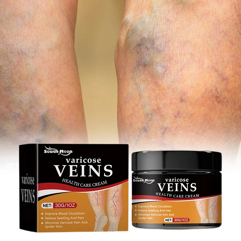 Крем для лечения варикозного расширения вен восстанавливает боль в ногах