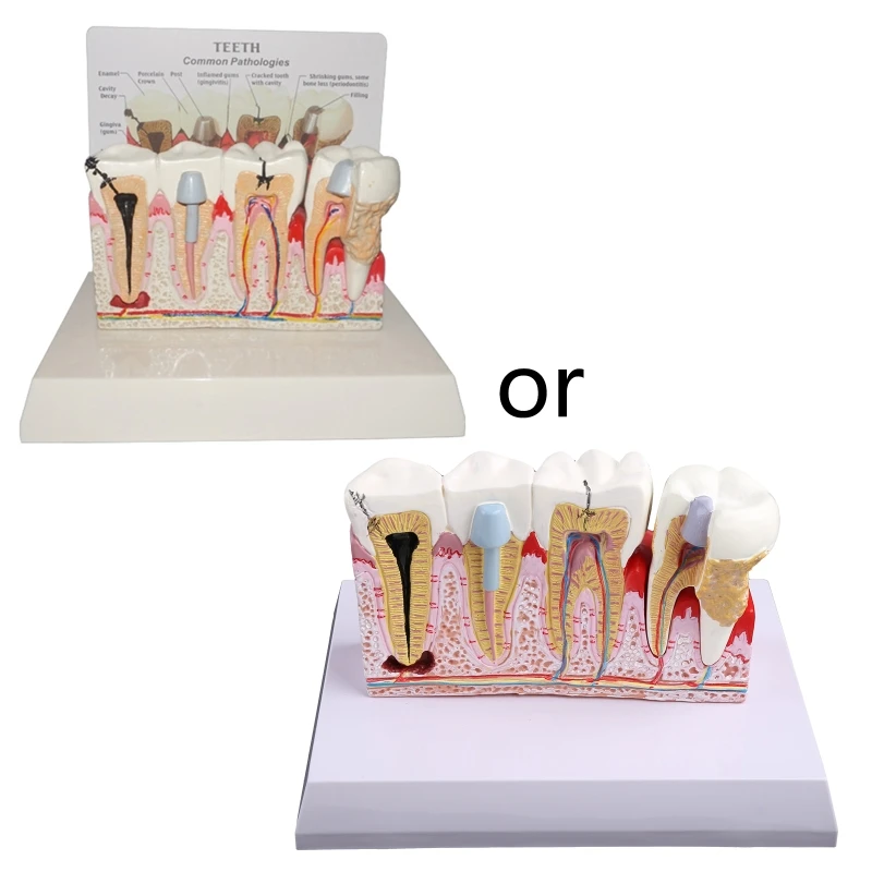 

7x5.9x5.1" Dental Caries Teeth Model Decay Teeth Model Suitable for Teaching Practice Study Teachers&Students Models