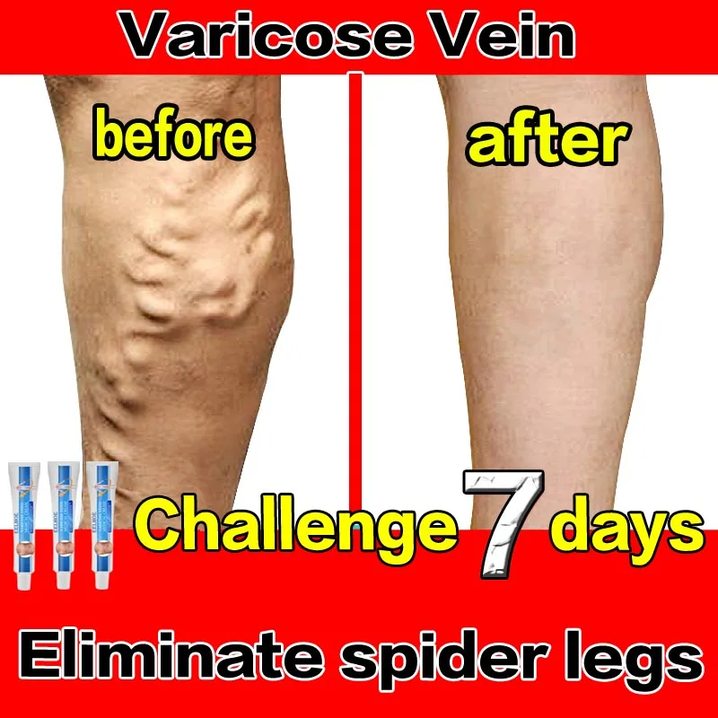 ointment for varicose veins Effective varicose vein relief cream to relieve vasculitis phlebitis spider pain treatment