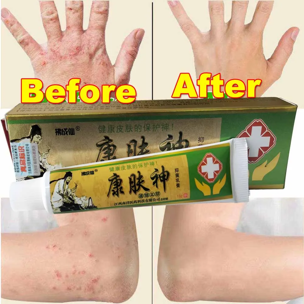 

Fungal Vesicle Antibacterial Cream Psoriasis Herbal Treatment Eczema Anti-itch Relief Rash Urticaria Desquamation Ointment KFS