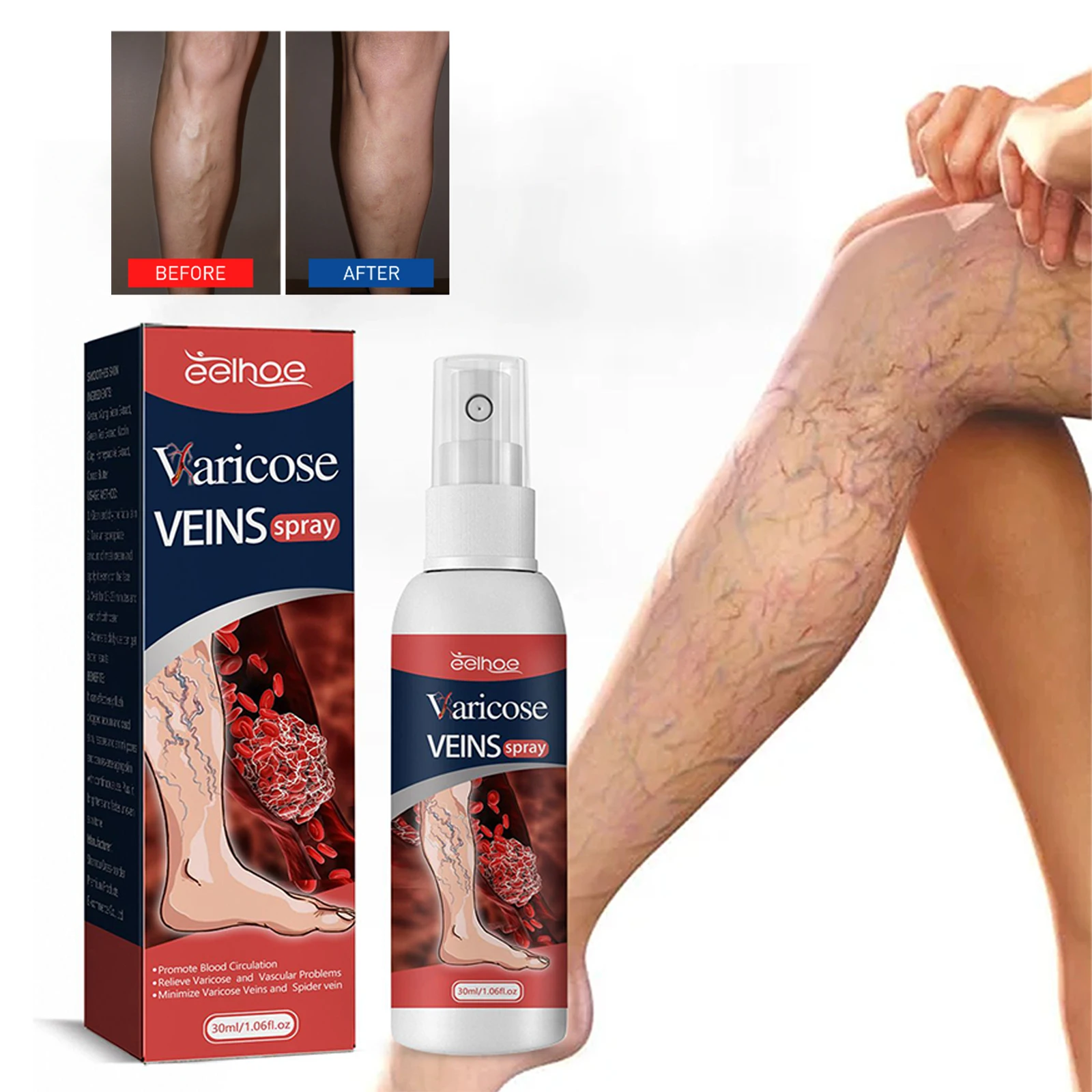 

Relieve Varicose Veins Spray Veinhealing Treatment Legs Swelling Pain Relief Phlebitis Spider Removal Earthworm Leg Care Spray