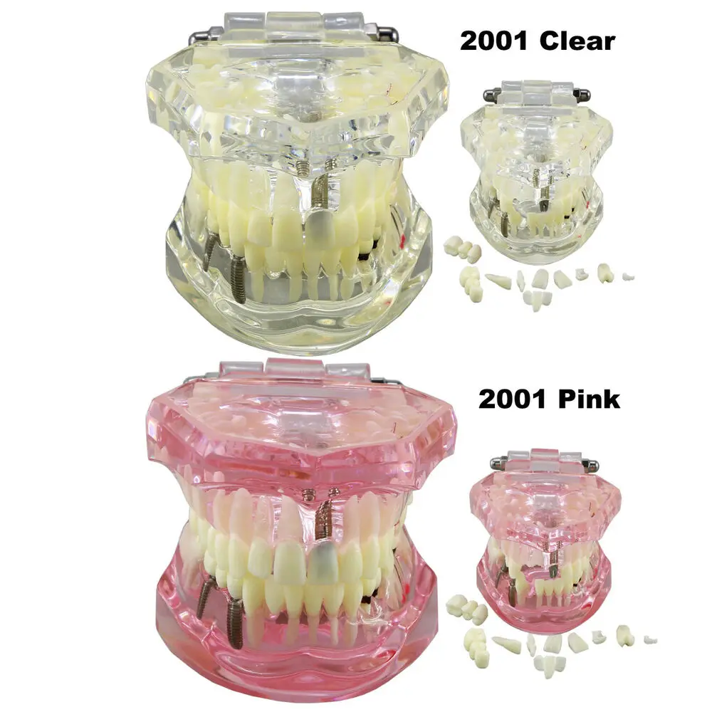 US Dental Implant Restoration Pathology Teach Study Teeth Model M2001 Pink Clear