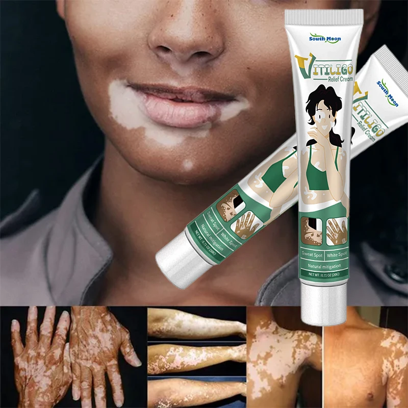 

Herbal Extract Vitiligo Ointment Remove Ringworm White Spot Removal Skin Vitiligo Eliminate Vitiligo Treatment Cream