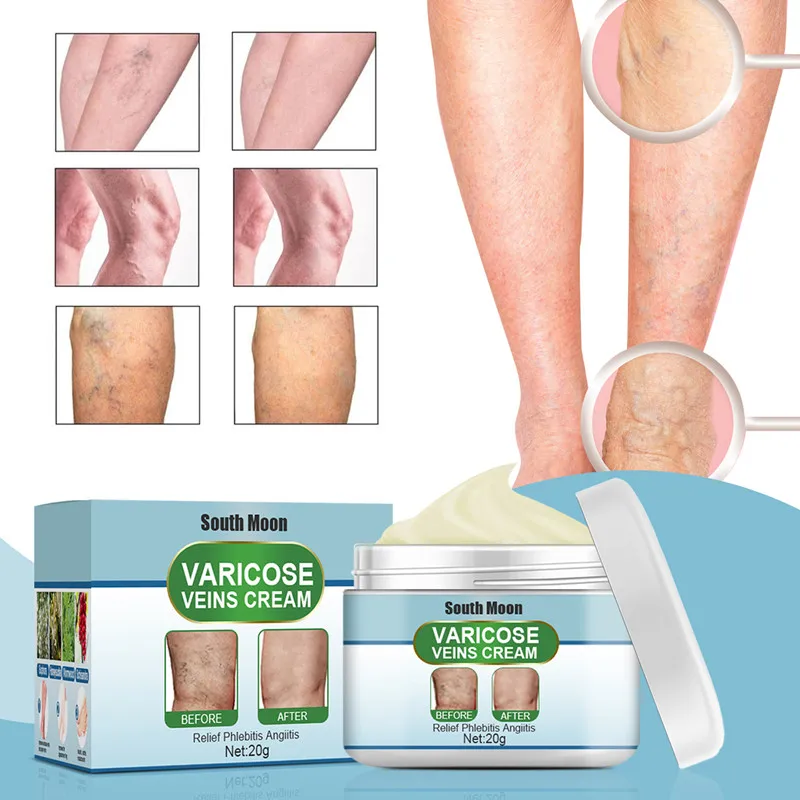 

Varicose Vein Repair Cream Effective Relieves Leg Varicose Vein Pain Relief Earthworm Leg Pain Red Blood Silk Spider Leg Product