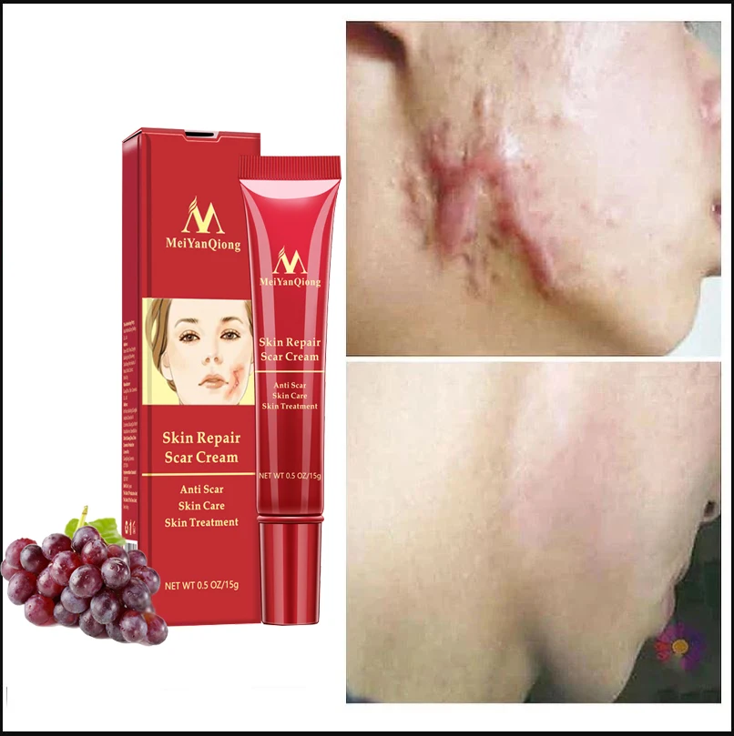 

15g Natural Remove Pregnancy Mark Body Ointment Treatment Scars Acne Stretch Marks Dressing Maternity Repair Body Creams
