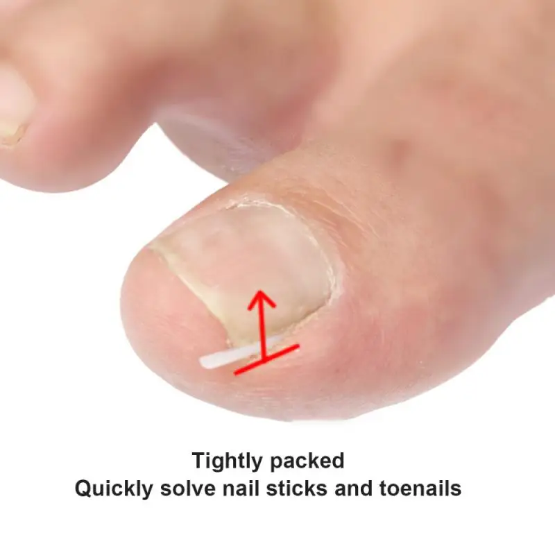 

10pcs Ingrown Nail Pad Filling Groove Toenail Corrector Feet Care Tools Quickly Solve