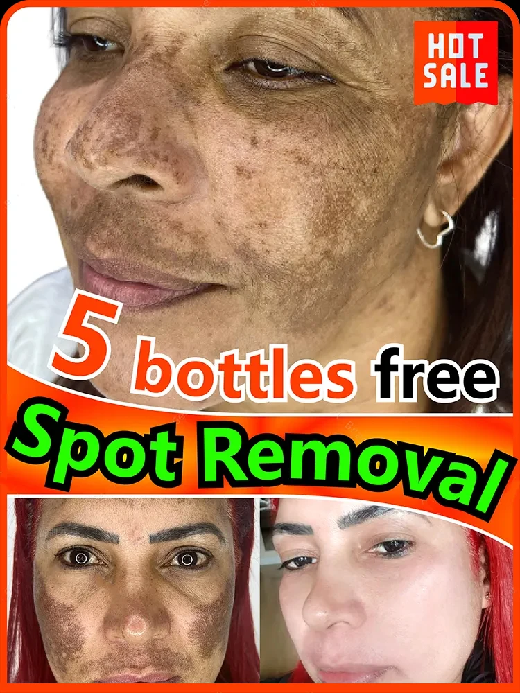 

Dark Spot Remover For Face Sun Melasma Freckles Pigment Age Spots Removal