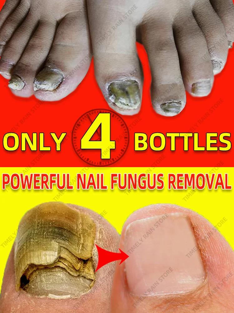 

Nail Fungus Treatment Oil Against Toenail Fungus Foot Nail Fungal Remover Anti Infection Onychomycosis Serum Cure Nail Fungus
