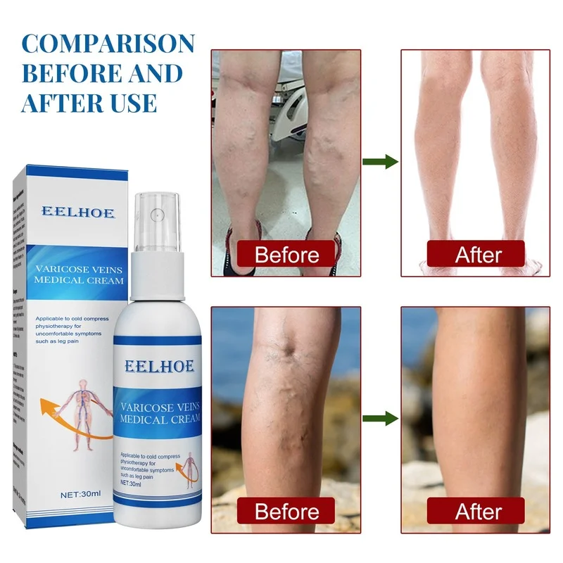 

EELHOE Intravenous Massage Spray To Relieve Leg Varicose Veins To Smooth Earthworm Leg Blood Vessel Pain Spray