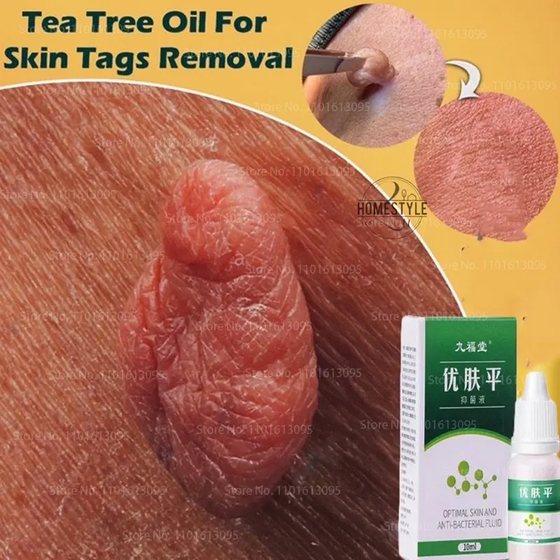 

Skin Tag Mole Wart Removal Buang Ketuat Kutil Essential Ubat Buang Tahi Lalat Kutil Biji Kolesterol Ketuat Krim