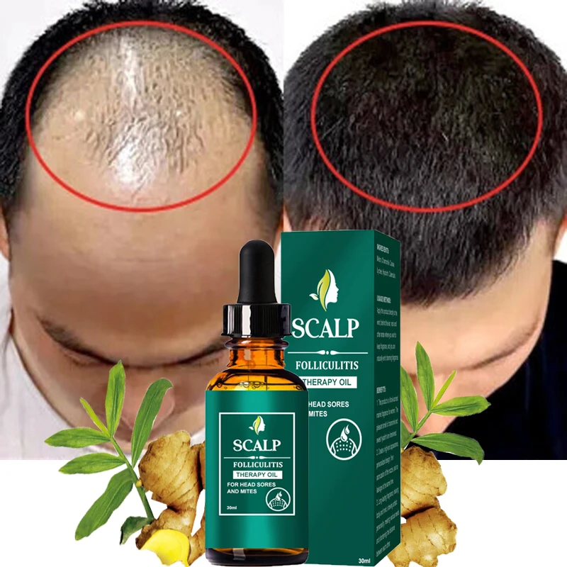 

10pcs Ginger Hair Growth Products Anti Hair Loss Serum Liquid Fast Grow Prevent Baldness Men Women Hair Care Essential Oil 30ml
