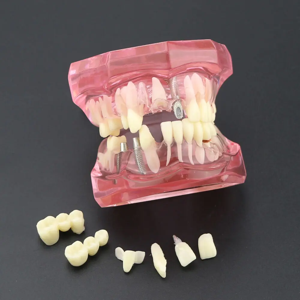 Dental Teeth Model Implant Study Analysis Demonstration With Restoration Pink