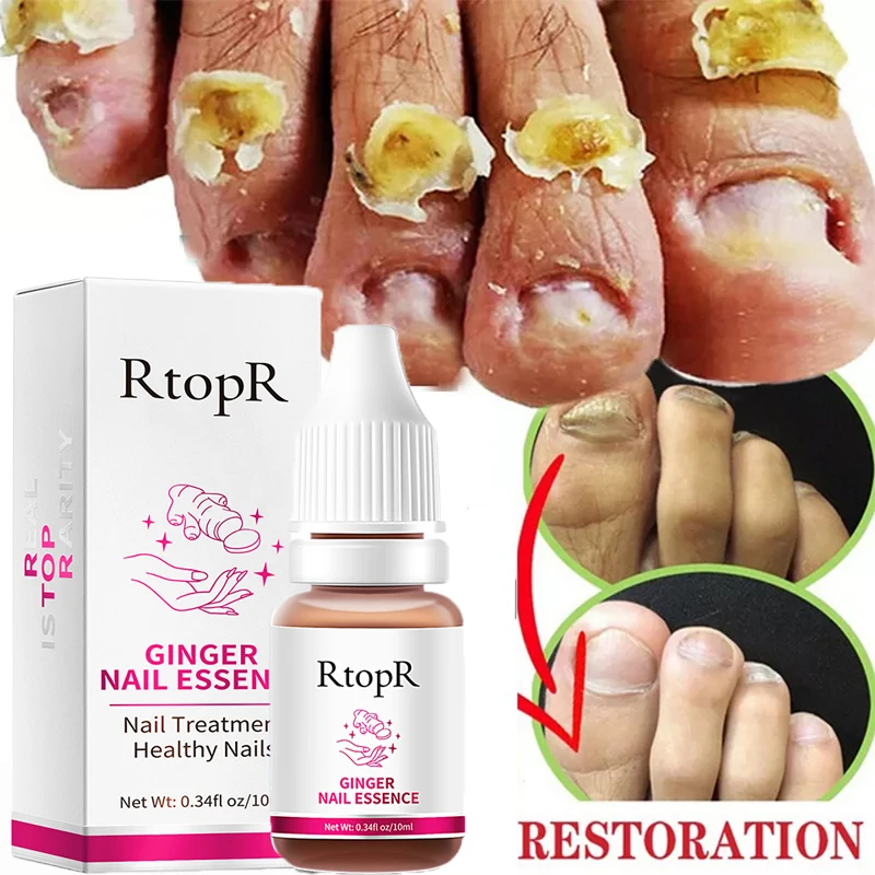 

Nail Fungal Treatment Serum Nail Fungus Onychomycosis Paronychia Anti Infection Repair Essence Toenail Nourishing Hand Feet Care