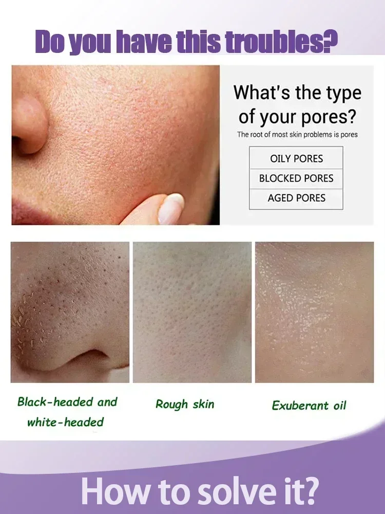 Сыворотка для минимизации пор кислота сужение удаление больших черных точек