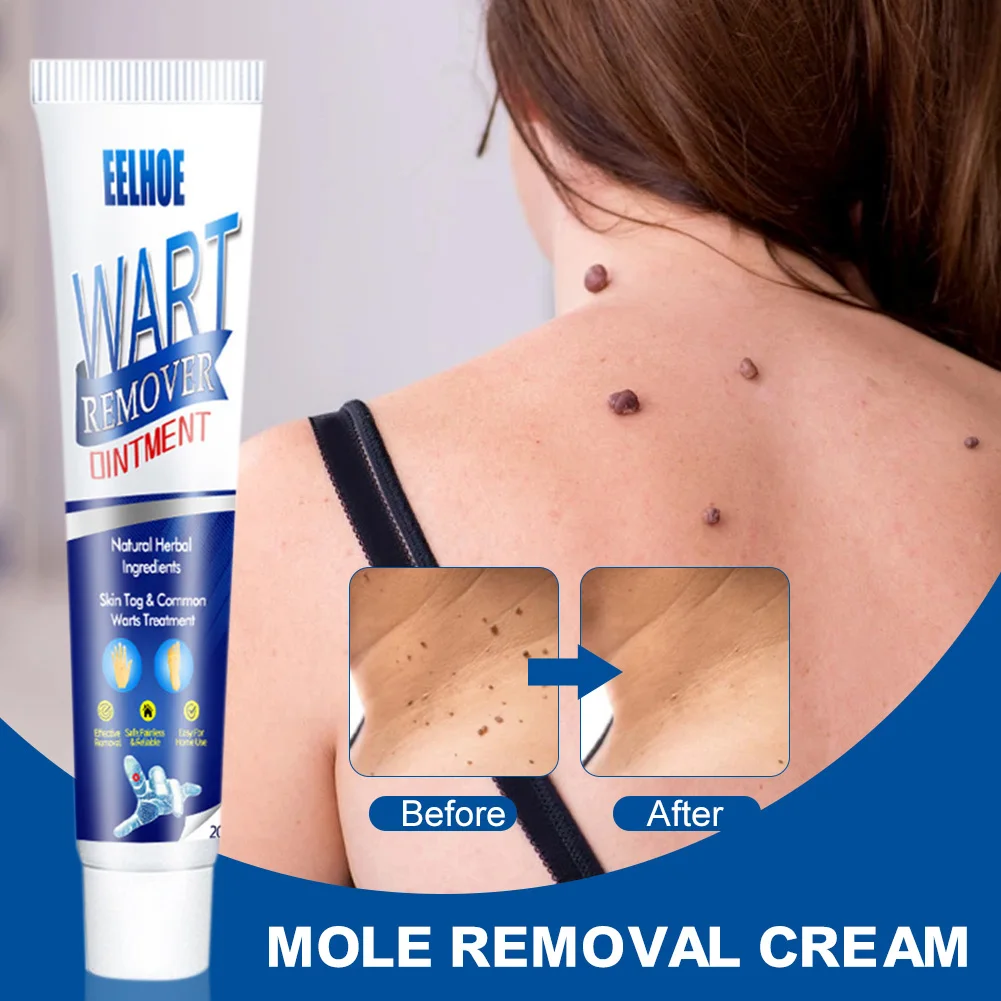 

Skin Tags Remover Cream Safe and Gentle Warts Mole Skin Tags Treatment Cream for Men Women Warts Removal