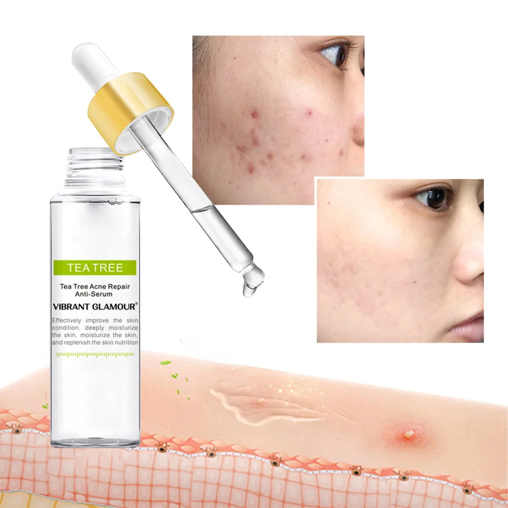 

Tea Tree Acne Treatment Serum Remove Acne Pimples Shrink Pores Oil Control Skin Repairing Moisturizing Serum